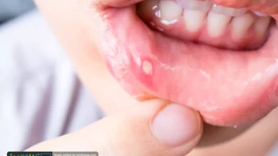 علائم آفت دهان کودکان