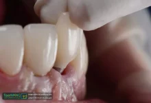 علت لق شدن ایمپلنت دندان