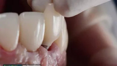 علت لق شدن ایمپلنت دندان