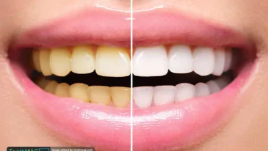 آیا بلیچینگ دندان عوارض دارد؟