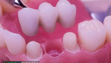 بریج دندان چیست؟ انواع بریج دندان