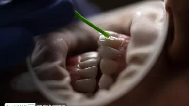 نکاتی که قبل از لمینت باید بدانید