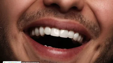 تفاوت لمینت دندان و کامپوزیت دندان